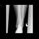 Ollier's disease, enchondromatosis: X-ray - Plain radiograph